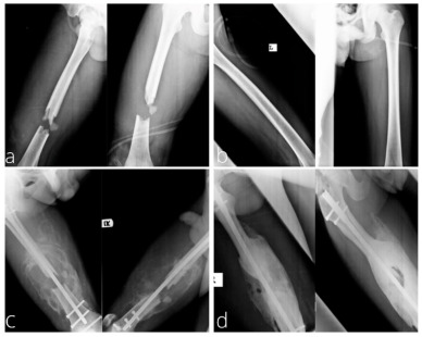 Exuberant callus formation