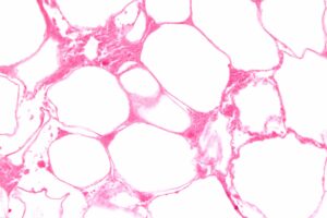 Example of fat necrosis