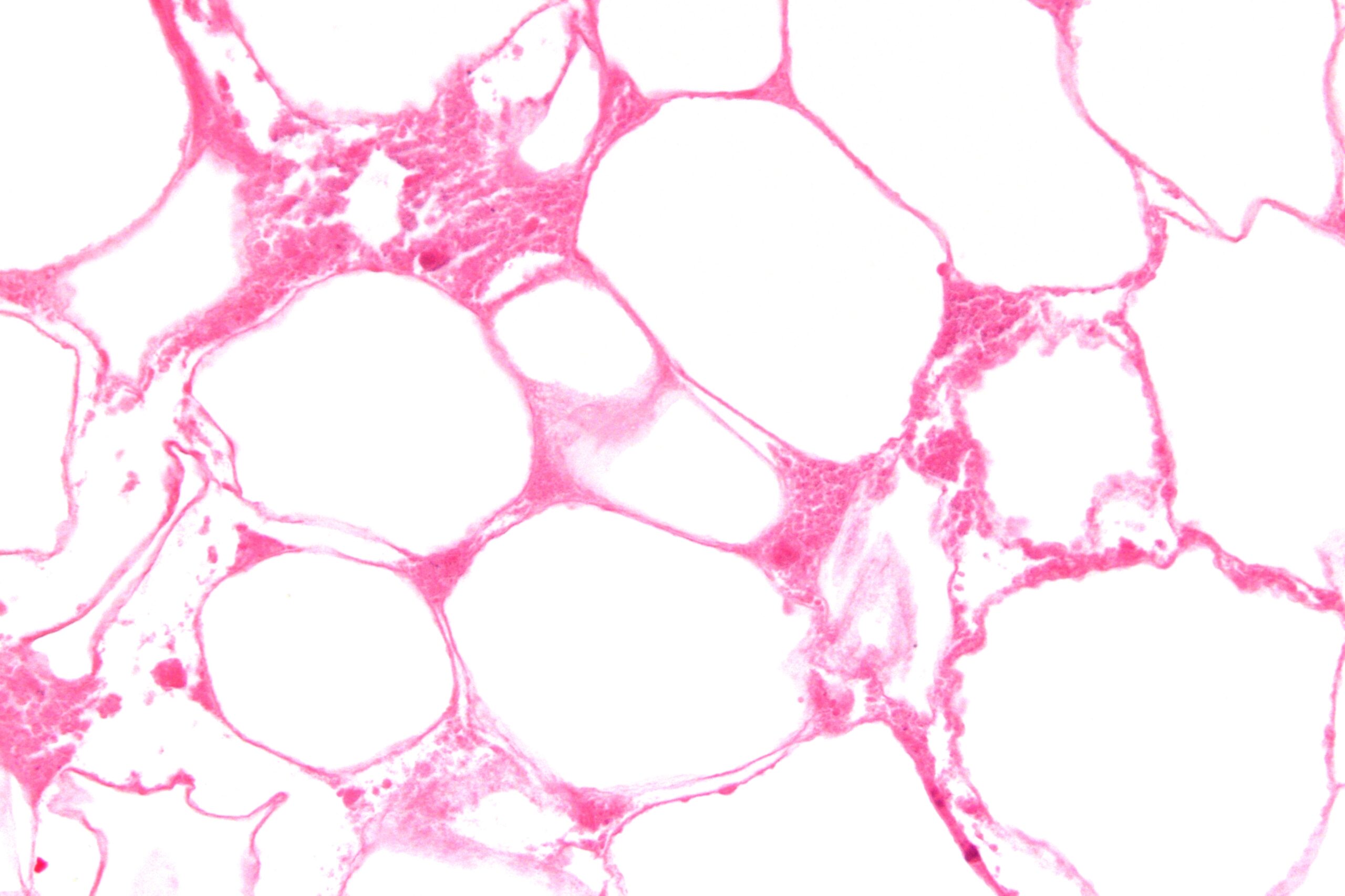 Example of fat necrosis