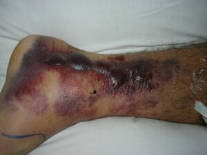 Hemorrhagic fracture blisters on medial aspect of left foot and ankle. A prior X-ray shows a fracture of the ankle.