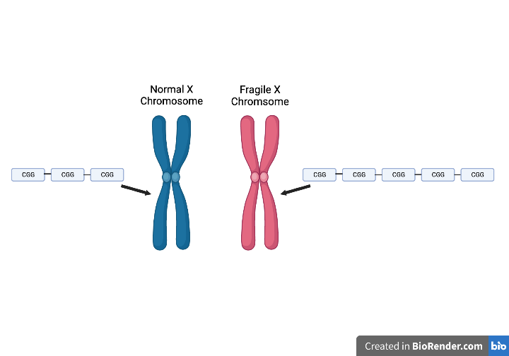 Example of a congenital multifactorial defect: Fragile X syndrome (mental health defects).