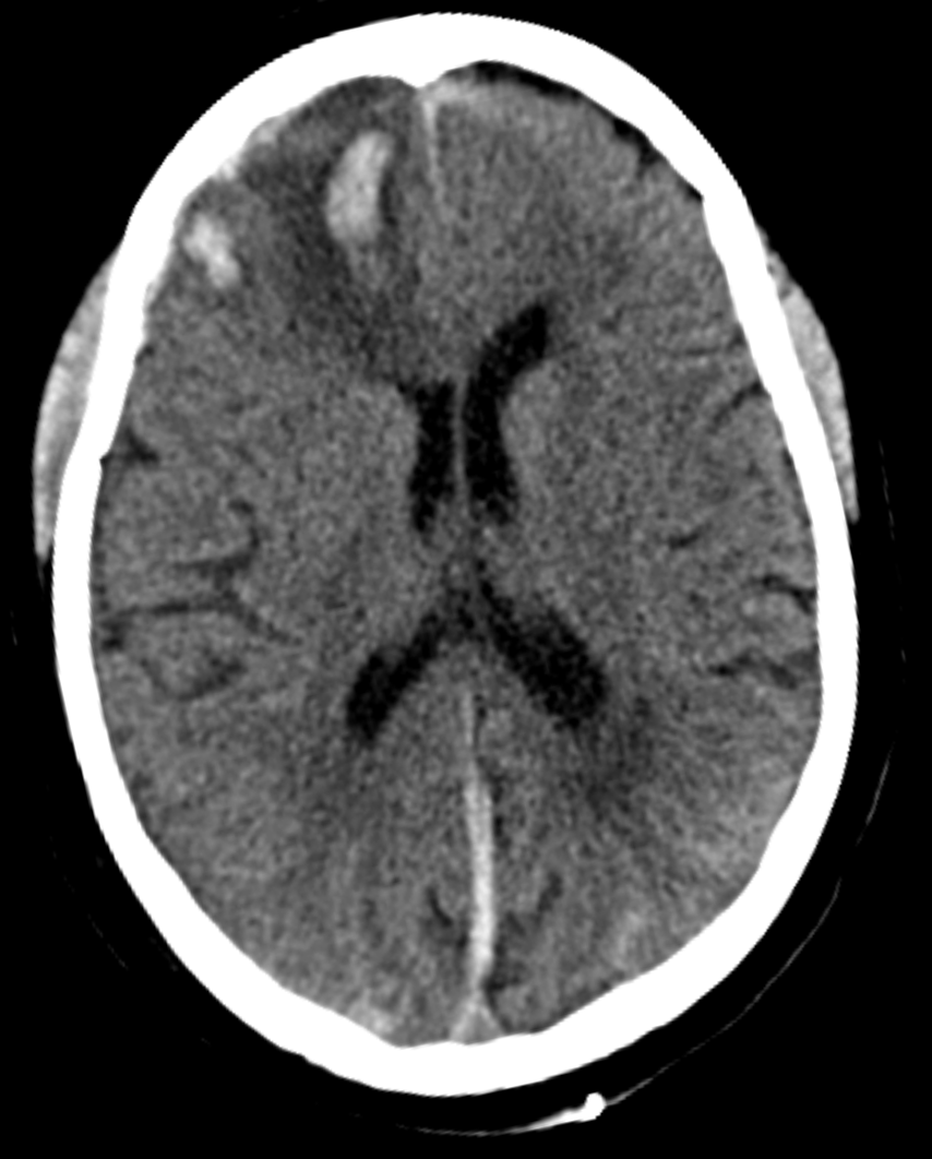 CT-scan of a frontal intracerebral hemorrhage on the right (left image side) as a contre coup. There is dens suture material visible left occipital in the skin.