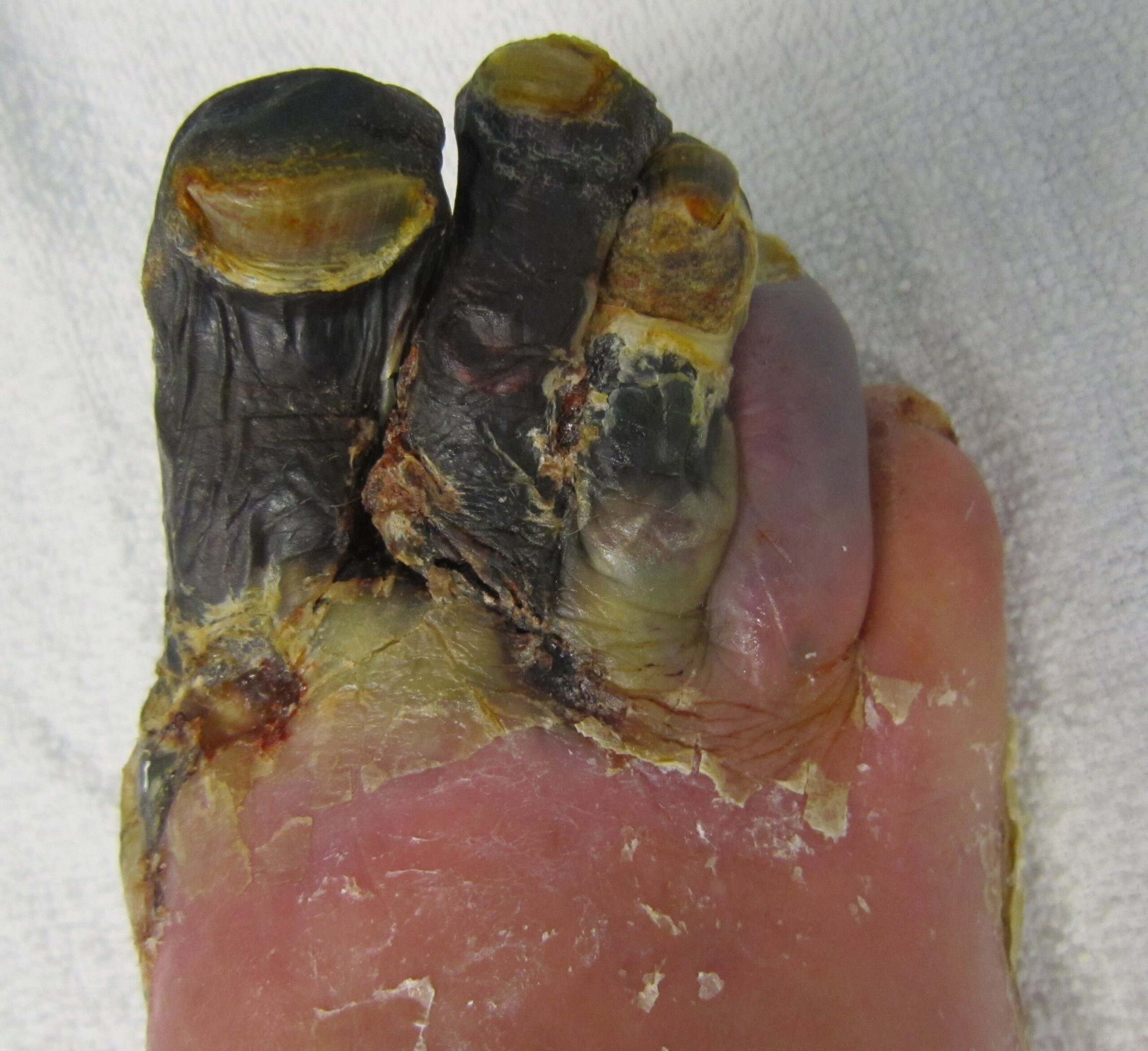 Example of gangrene