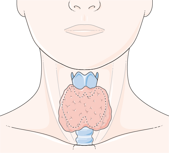 Hashimoto thyroiditis is an autoimmune disease in which the immune system attacks healthy cells of the thyroid, which results in a reduction in thyroid hormone production. Enlarged thyroid glands (goiters), weight gain, lethargy, and muscle weakness are common symptoms.