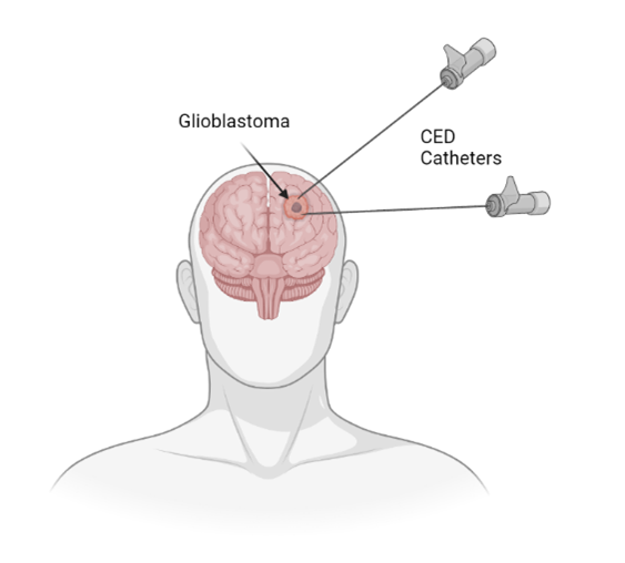 Glioblastoma Treatment