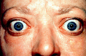 Grave's Disease is an autoimmune disease that can result in a hyperactive thyroid (hyperthyroidism). Some patients can develop thyroid eye disease, where their eye muscles and tissues swell, leading to proptosis and eyelid retraction.