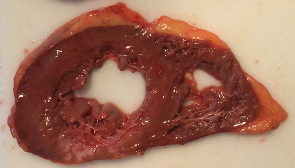 Example of infarction