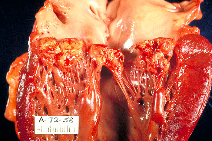 Vegetative lesions (in white box) associated with Infective endocarditis