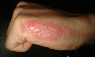 Example of a temperature burn