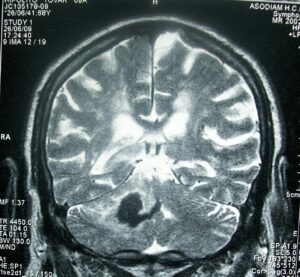 Head MRI stroke.