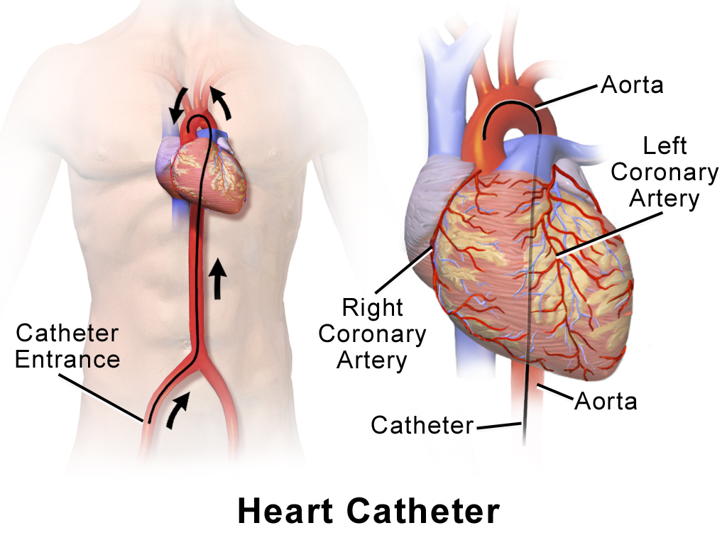 Cardiac Catheterization