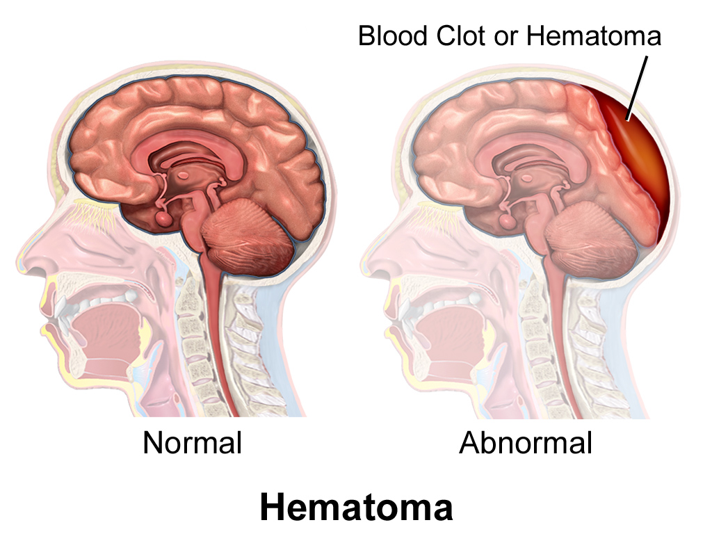 Hematoma Comparison.