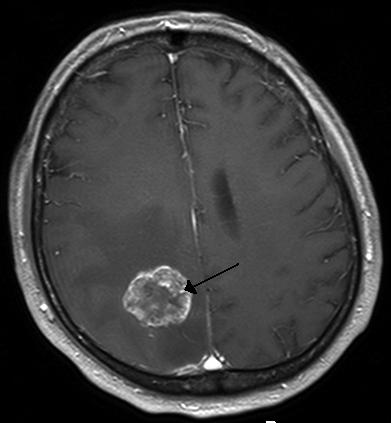 Figure 4. A metastatic tumor in the cerebral hemisphere from lung cancer, shown on magnetic resonance imaging.