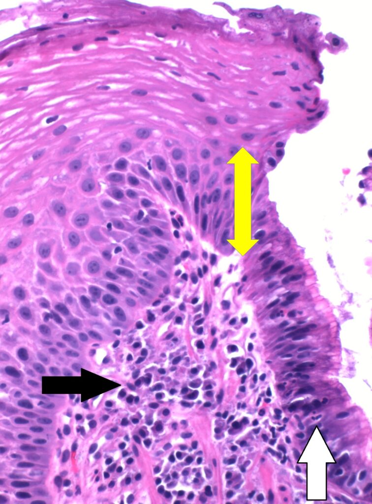Histopathology of the gastro-esophageal junction, showing a chronic inflammation including plasma cells (black arrow), acute inflammation with neutrophils (white arrow), as well as basal layer hyperplasia exceeding 15 - 20% of the epithelial thickness (yellow double-headed arrow). These together indicate reflux esophagitis.