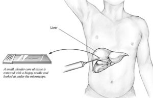 Percutaneous liver biopsy collected using a hollow needle inserted between the ribs on the right side, often performed to monitor fatty liver disease, cirrhosis (advance liver damage and scarring), or investigate other unexplained causes of jaundice (symptom of liver dysfunction).