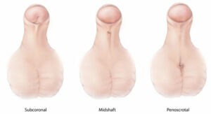 Example of congenital multifactorial defect: hypospadias.