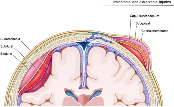 Illustration depicting hemorrhages by location within the different layers of the meninges (left of image) and scalp (right of image)