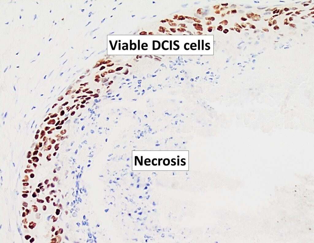 Example of carcinoma in situ