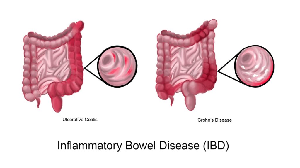 Example of an inflammatory disease