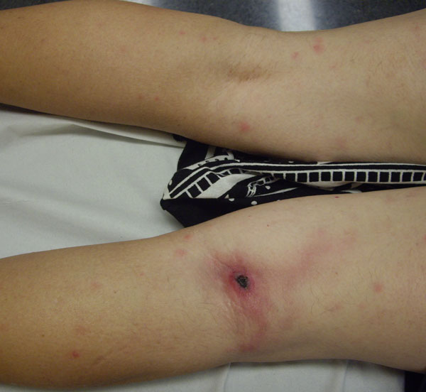Eschar on the back of the knee on a patient with lymphangitis caused by Rickettsia sibirica
