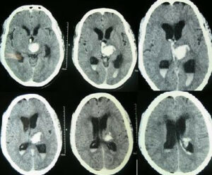 Intracerebral hemorrhage.