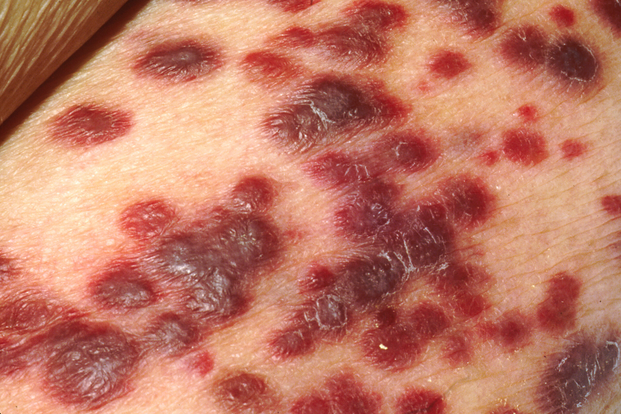 Example of a neoplastic disease