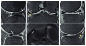 "Knee MR imaging of types of meniscal tears. A: longitudinal tear. The sagittal FS PD-weighted image of a 25-year-old male shows a peripheral longitudinal tear of the LM posterior horn, also known as a Wrisberg tear (white arrow). B-C: horizontal tear. Coronal and sagittal FS PD-weighted image, respectively, of a 30-year-old woman, shows a horizontal tear of the MM body and posterior horn (white arrow), contacting the inferior articular surface (white arrow in C), with extrusion and a displaced fragment extending to the tibial-meniscus recess (yellow arrow). D-E: radial tear. Sagittal and axial FS PD-weighted image, respectively, of a 19-year-old male, shows a vertically oriented cleft (white arrow) involving the LM at the junction of the body and anterior horn and the oblique course of the radial tear (white arrow in E) with respect to the sagittal plane. F: complex tear. Sagittal FS PD-weighted image of an 18-year-old male shows horizontal (white arrow) and vertical (yellow arrow) components of a MM complex tear.