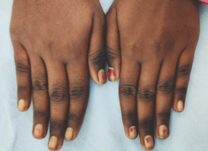 vitamin B12 deficiency Example of nutritional deficiency: Hyperpigmentation of knuckles, along with other parts of the extremities, is characteristic of vitamin B12 deficiency.