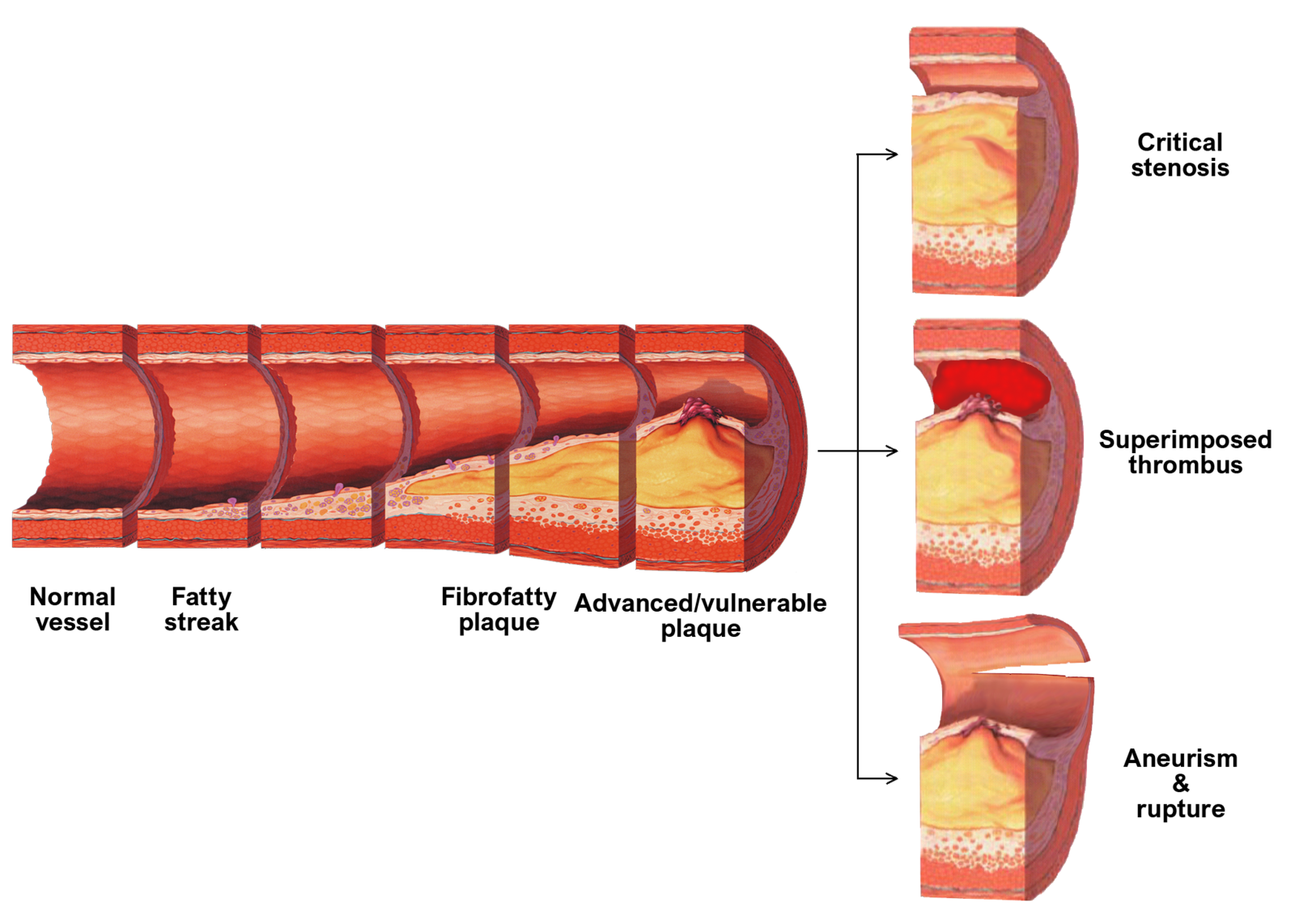 Late complications of atherosclerosis