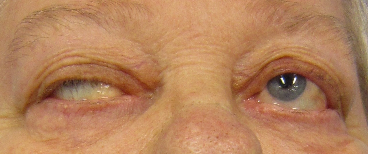 Muscle weakness in the voluntary muscles of the eyes and other muscles of the body is common in patients suffering from myasthenia gravis (MG), an autoimmune disease in which the immune system attacks the communication between nerves and muscle.