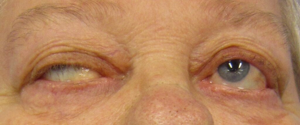 Muscle weakness in the voluntary muscles of the eyes and other muscles of the body is common in patients suffering from myasthenia gravis (MG), an autoimmune disease in which the immune system attacks the communication between nerves and muscle.