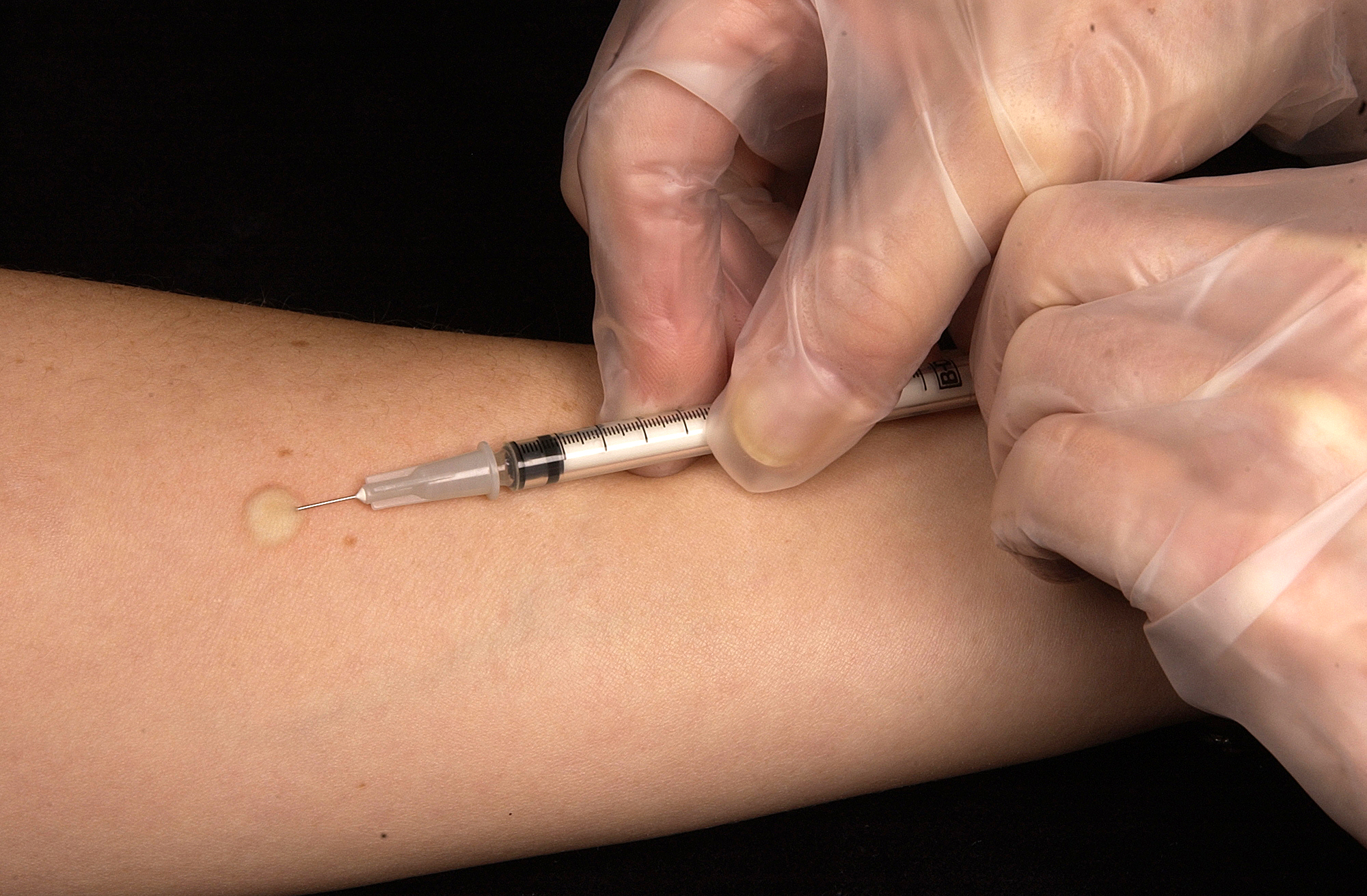 The Mantoux tuberculin skin test is used to evaluate people for exposure to Mycobacterium tuberculosis, the bacterial causal agent of tuberculosis (TB). A small amount of fluid (tuberculin) containing TB proteins (antigens) is injected under the top layer of skin on the inner forearm, Within 48-72 hours, the injection site reaction must be evaluated by a healthcare professional. A positive or negative results is determined based on the size of size of the hard, raised area, as well as swelling.