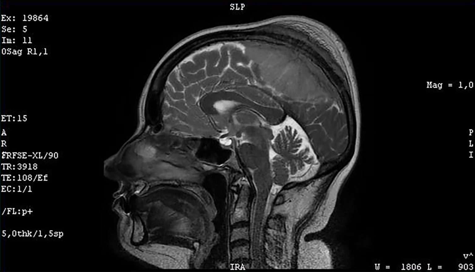 Figure 3. A meningioma, a benign tumor that developed in the meninges (thin membrane covering the brain), has caused a large hyperostosis (excessive bone growth of the skull).