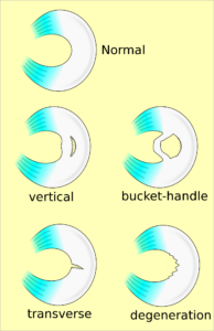 Types of meniscal tear.