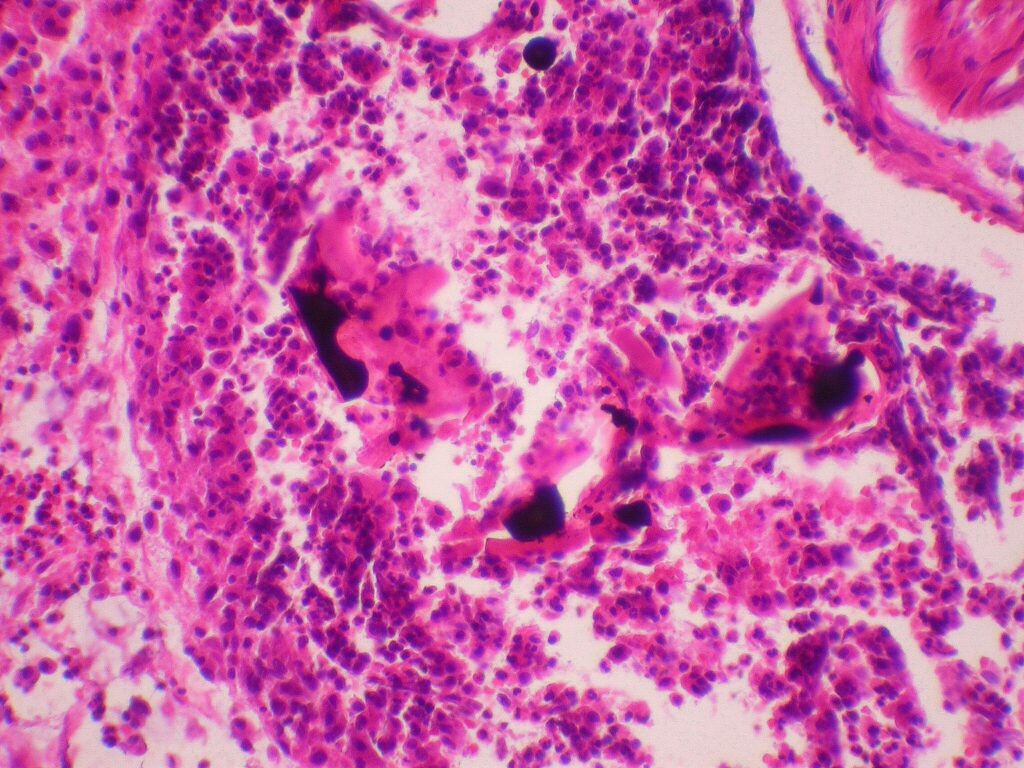 Cutaneous mercury granuloma is a rare disorder caused by the introduction of elemental mercury (Hg) into skin. treat an open wound.