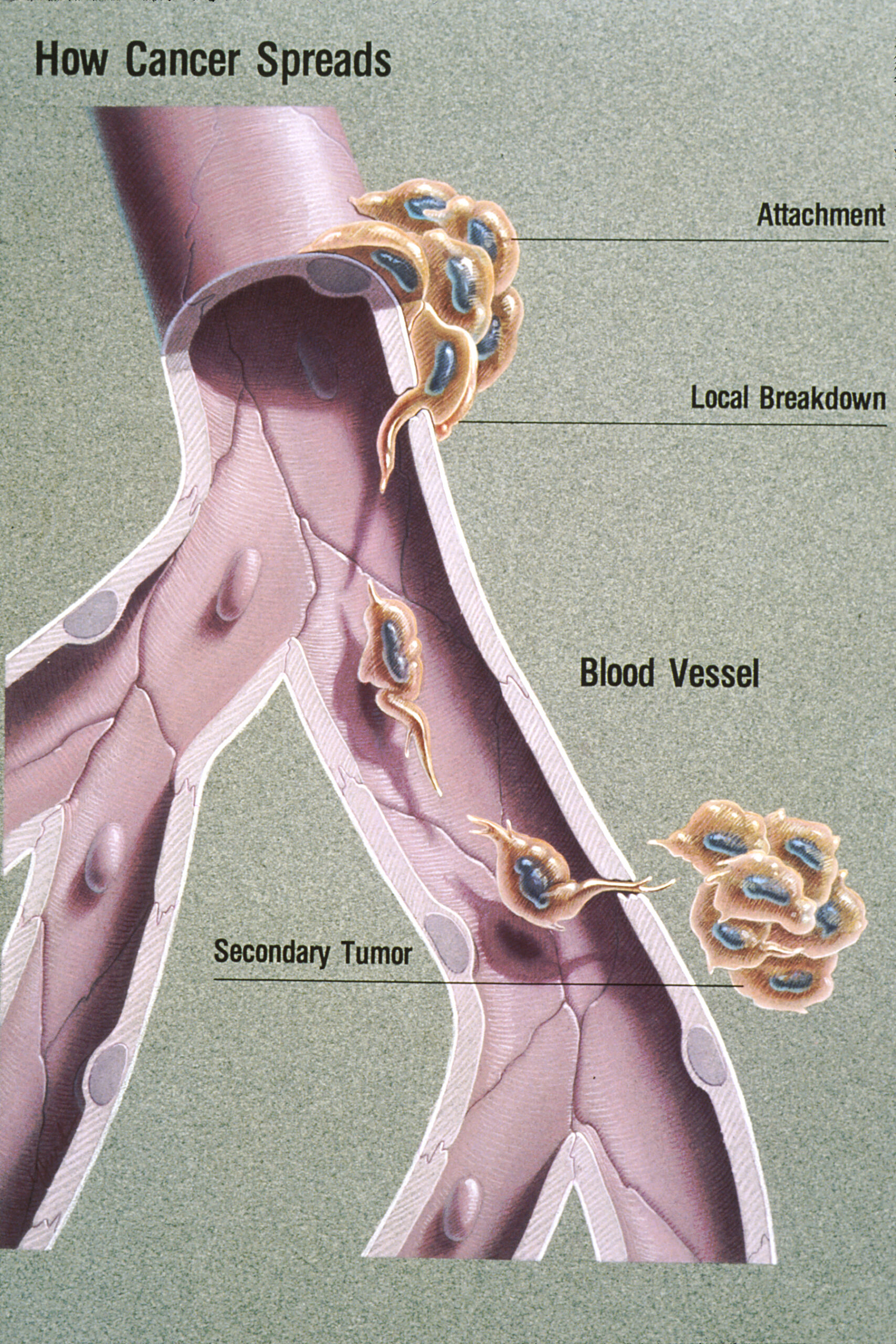 Figure of metastasis process