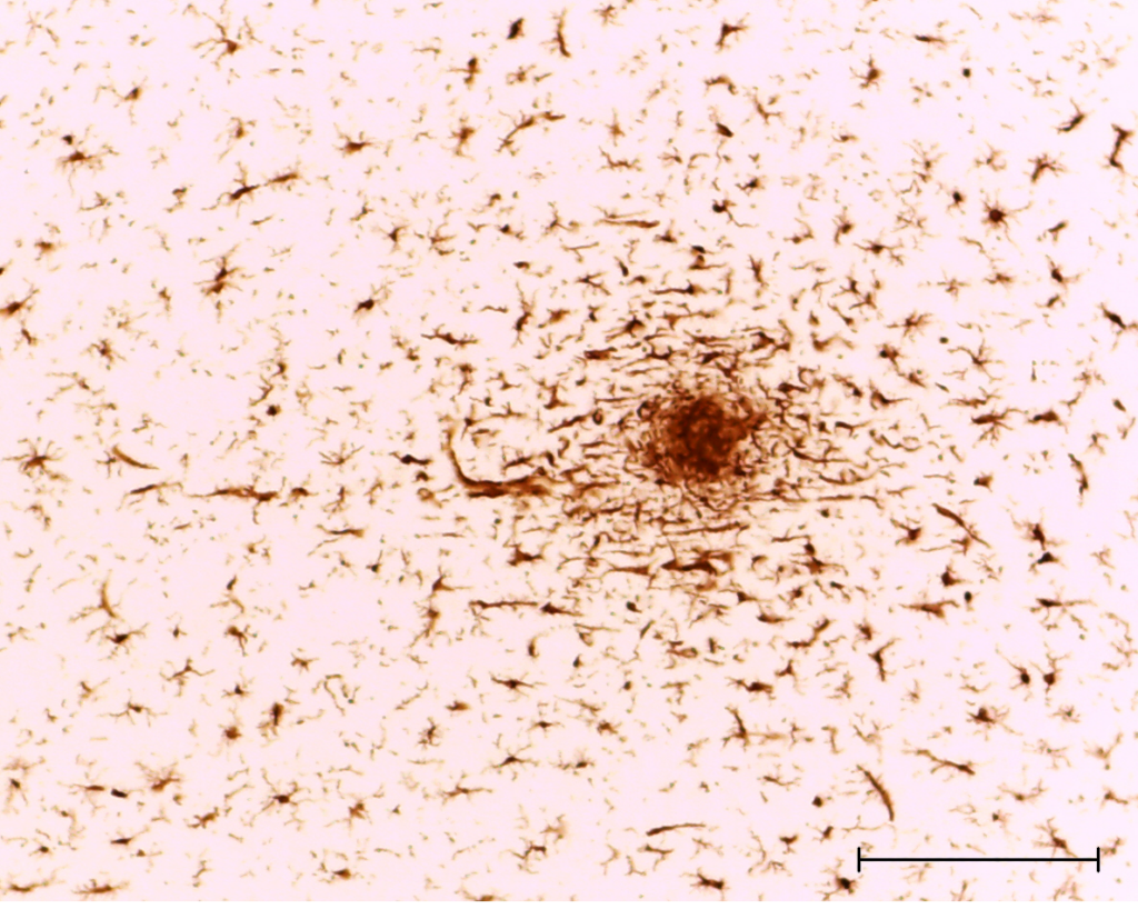 Example of cause of inflammation: microglia