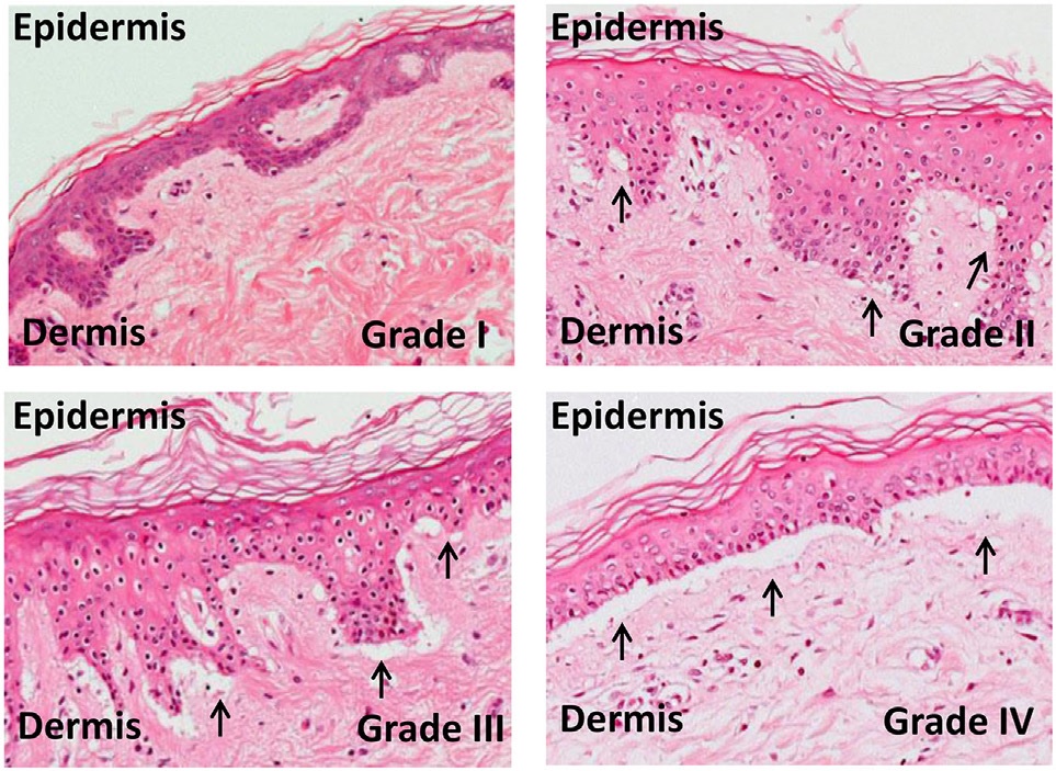 skin graft-versus-host-disease
