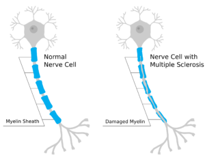 Normal nerve cell with myelinated axon in comparison to a nerve cell with multiple sclerosis and damaged myelin sheath