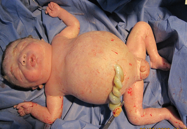 Newborn infant with severe hemolytic disease.
