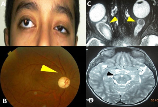 Optic nerve glioma.