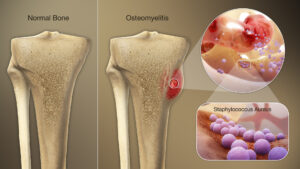 Osteomyelitis