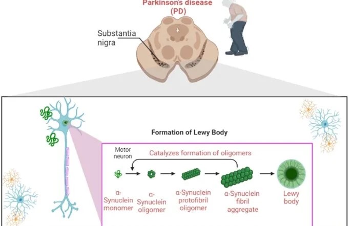 Example of abnormal protein preparation: Parkinson's disease