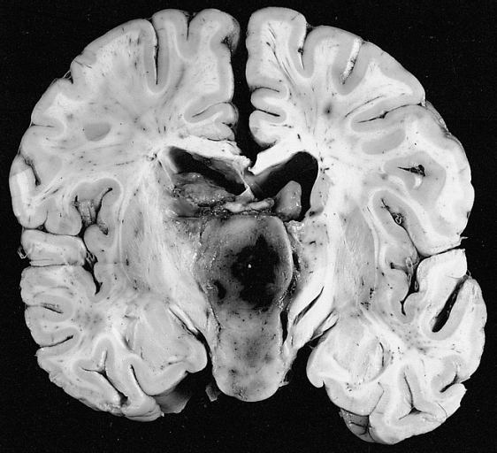 Pilocytic astrocytoma of the hypothalamic region.