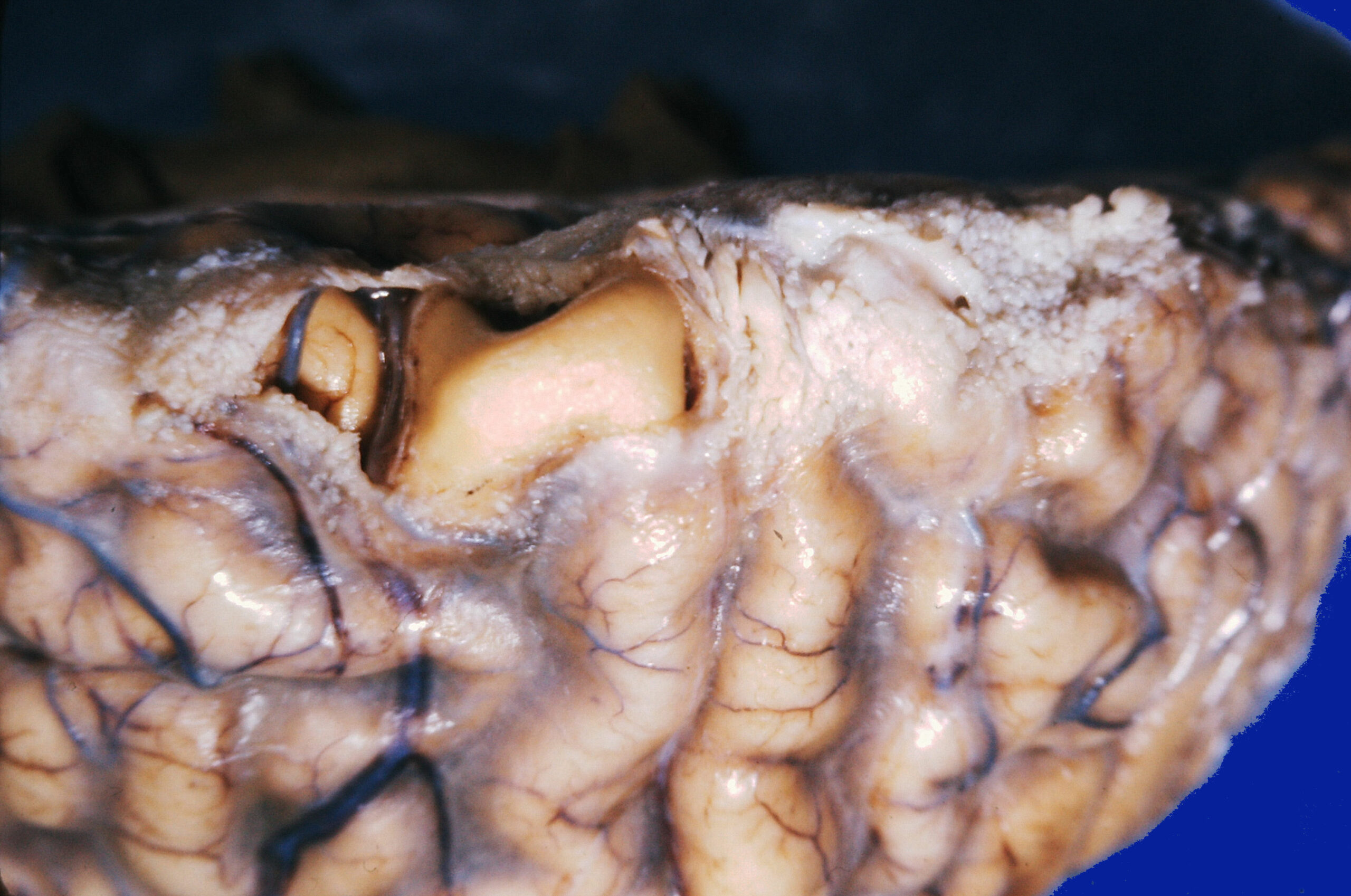 Pneumococcal meningitis.