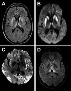 FLAIR-MRI of Creutzfeldt–Jakob disease.