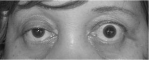 Ptosis myasthenia gravis.