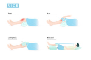 RICE: rest, ice, compression, and elevation