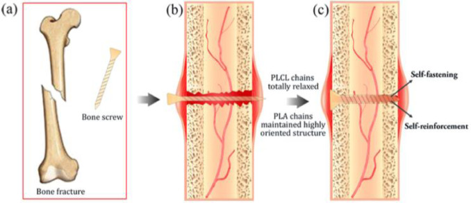 Realignment of fracture ends