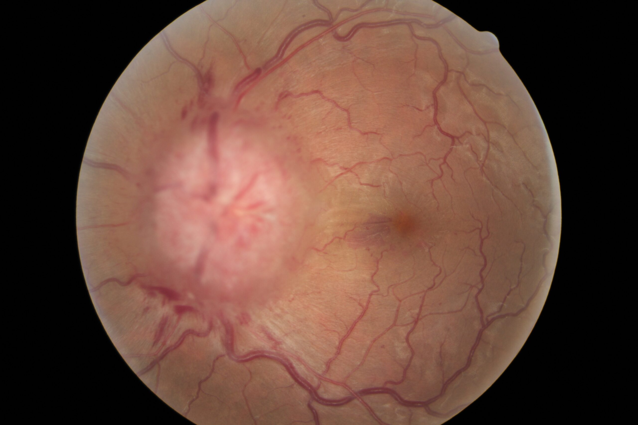 Retina photo of a left eye, patient with severe Idiopathic Cranial Hypertension (aka Psuedotumor Cerebri).
